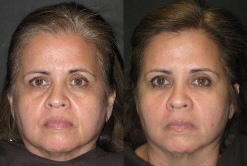 Botox injected in Forehead, Glabella, Crows-Feet