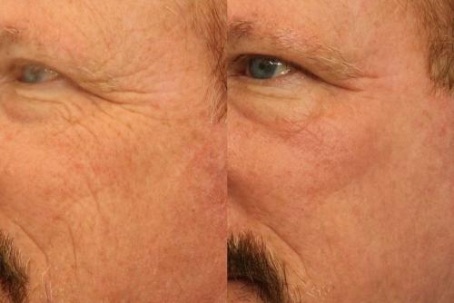 Four Photofractional Treatments (Full Face)