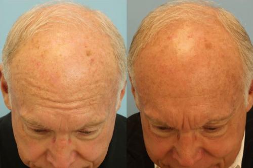 Two IPL and Two Photofractional Treatments (Face and Scalp)