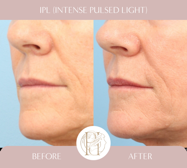 4 Treatments of IPL