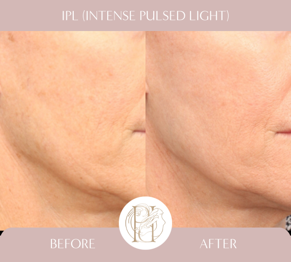 4 Treatments of IPL