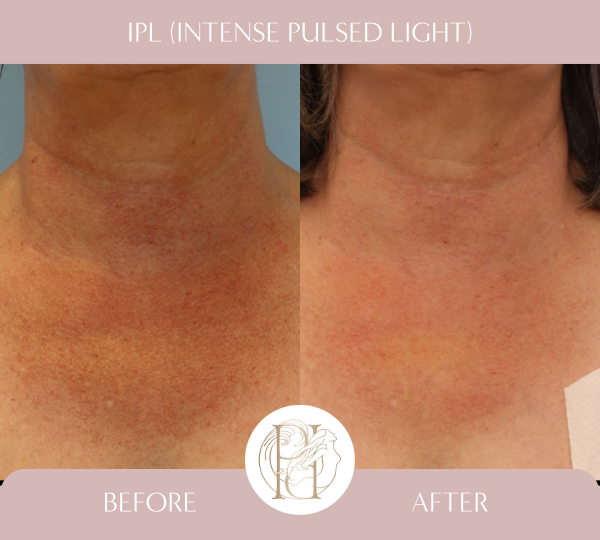 IPL (4 Treatments)