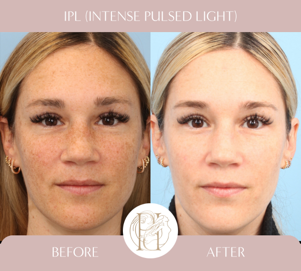 IPL Full Face