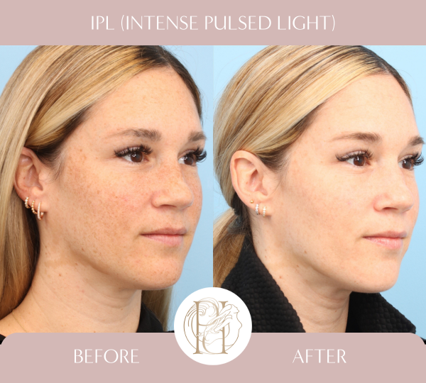 IPL Full Face