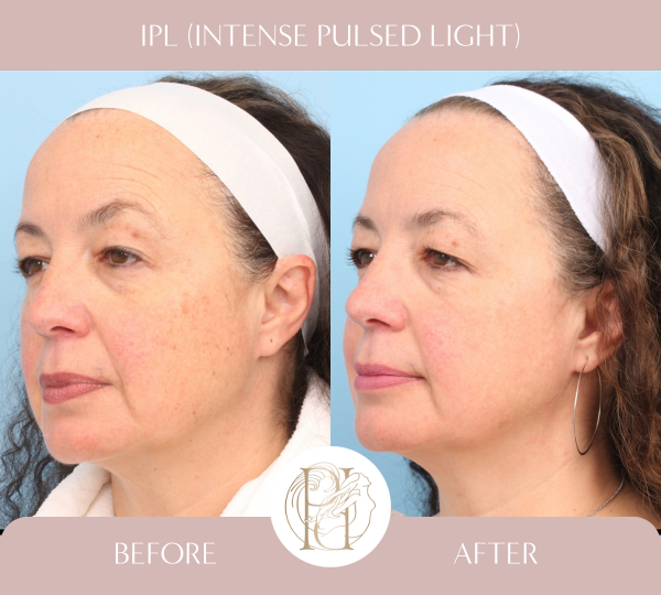 3 Treatments of IPL