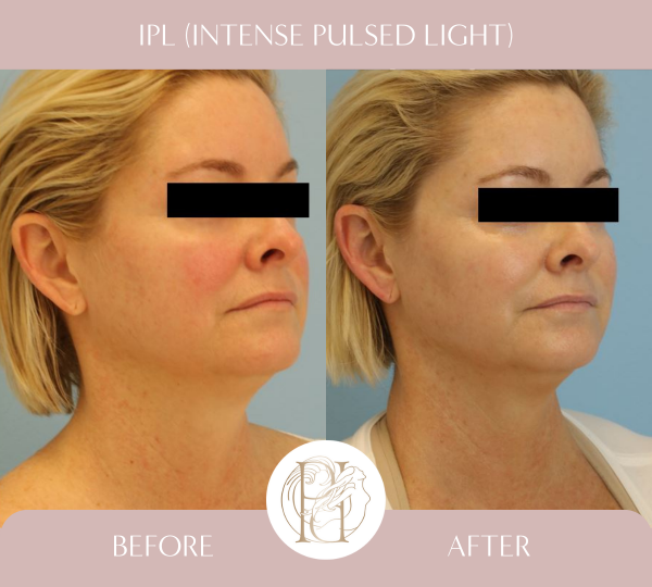 3 Treatments of IPL (Photofacial) for face, neck and chest