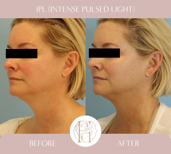 3 Treatments of IPL (Photofacial) for face, neck and chest