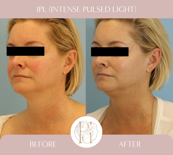 3 Treatments of IPL (Photofacial) for face, neck and chest