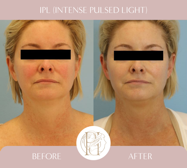 3 Treatments of IPL (Photofacial) for face, neck and chest