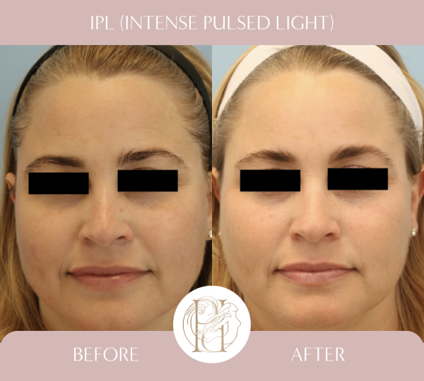 3 Treatments of IPL (Photofacial)