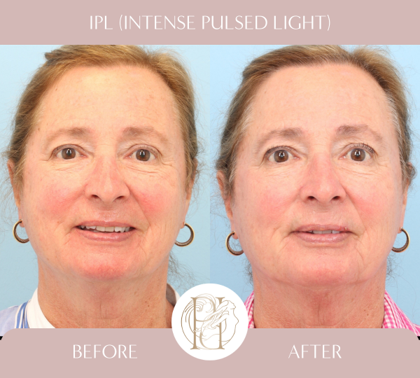 IPL (3 Treatments)