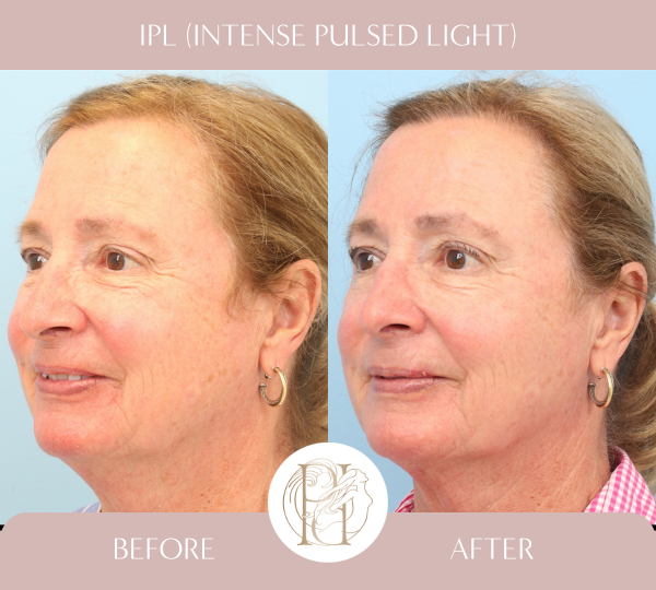 IPL (3 Treatments)