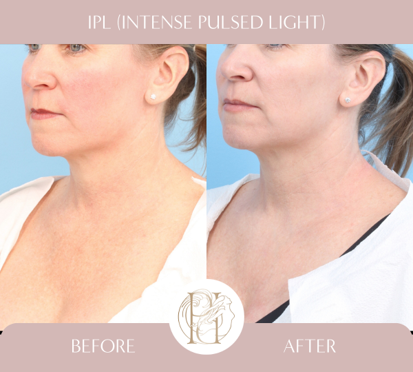 Received 3 treatments of the IPL on her face, neck, and chest