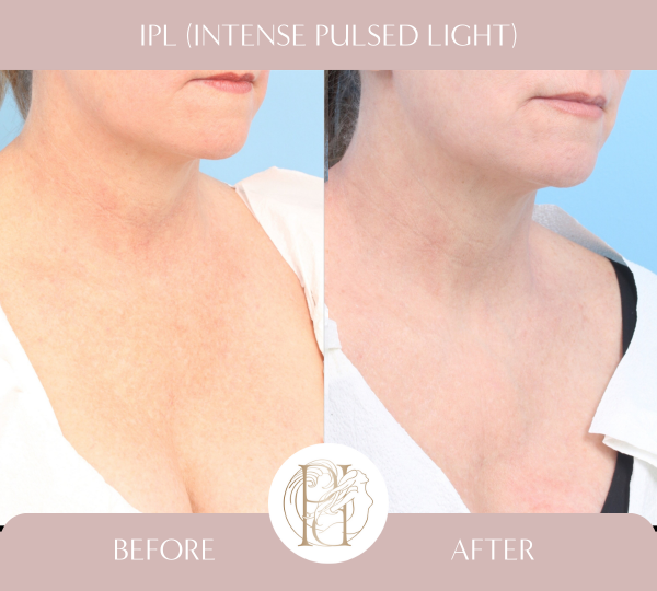 Received 3 treatments of the IPL on her face, neck, and chest