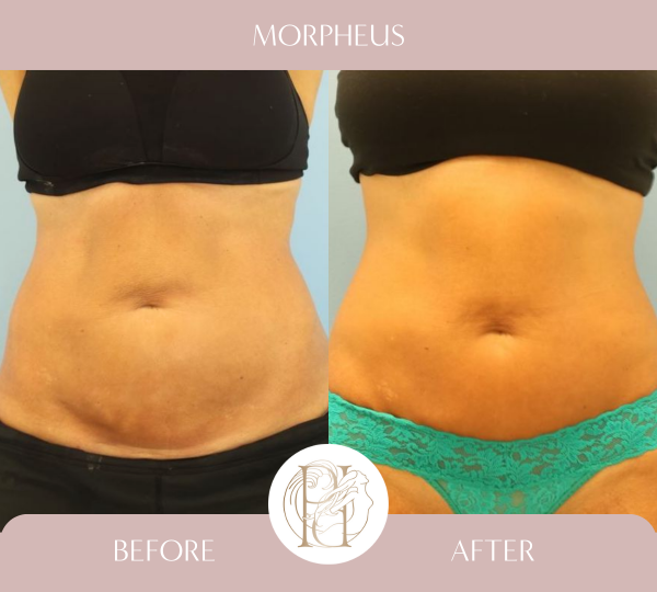 Morpheus RF After 2 Treatments to Abdomen