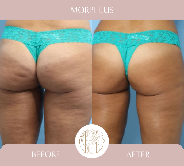 Moprhues RF to Posterior thighs and QWO - buttocks