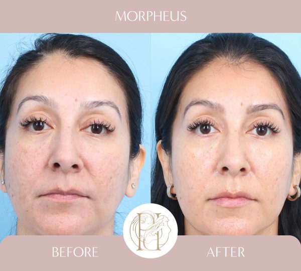 Morpheus - Acne Scars 1 of 3