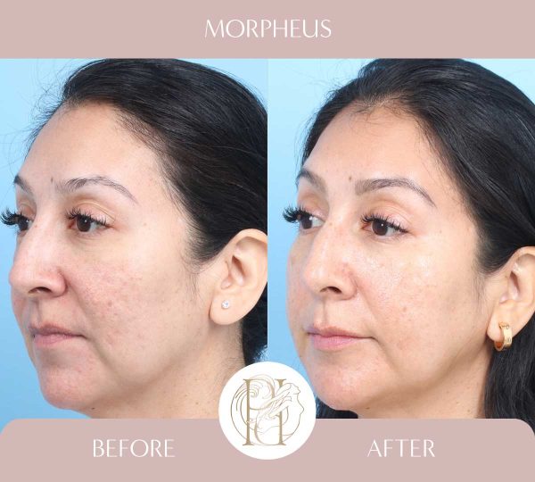 Morpheus - Acne Scars 2 of 3
