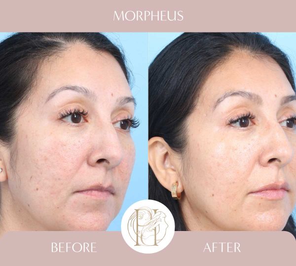 Morpheus - Acne Scars 3 of 3
