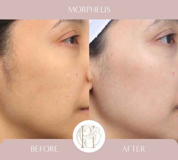 Morpheus - Cheeks 1 of 2