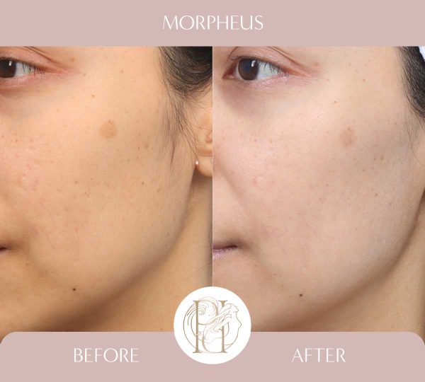 Morpheus - Cheeks 2 of 2