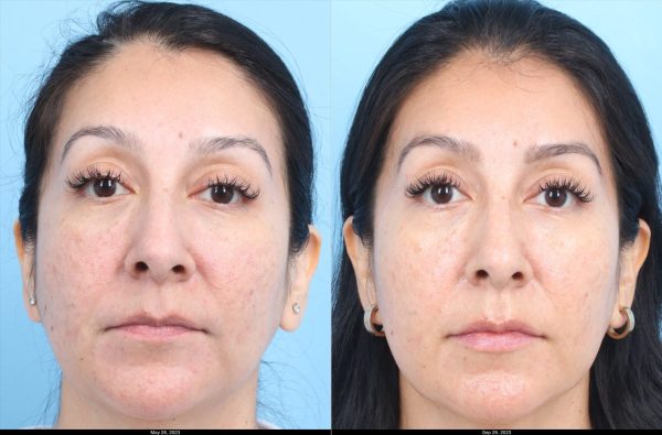 Morpheus-Johnson-Acne-Scars-1-3-treatments