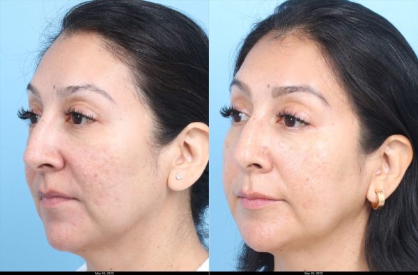 Morpheus-Johnson-Acne-Scars-2-3-treatments