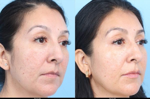 Morpheus-Johnson-Acne-Scars-3-3-treatments