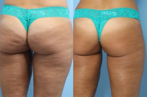 Moprhues RF to Posterior thighs and QWO - buttocks