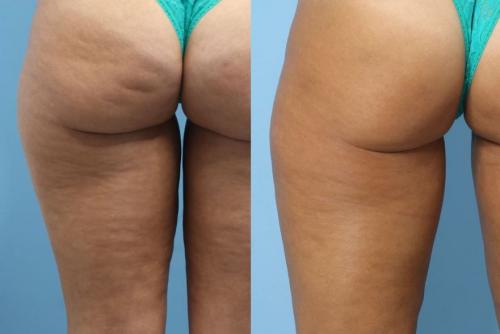 Moprhues RF to Posterior thighs and QWO - buttocks