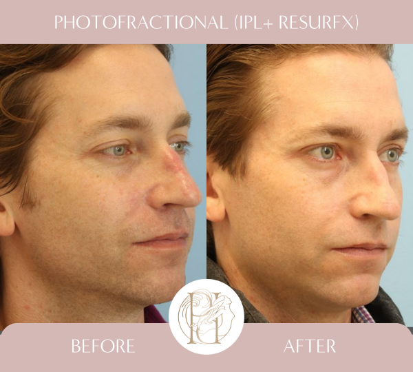 Patient had 3 photofractional (IPL + ResurFx) for cheeks & nose.