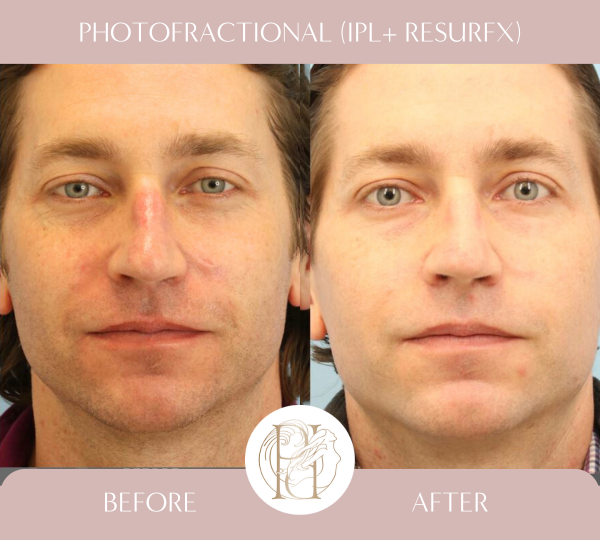 Patient had 3 photofractional (IPL + ResurFx) for cheeks & nose.