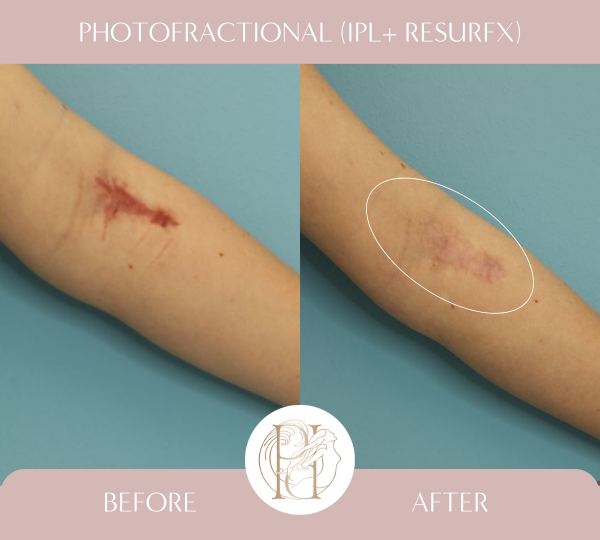 5 treatments with Photofractional (IPL + ResurFX)