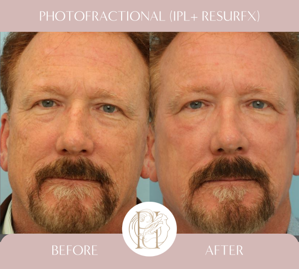 Four Photofractional Treatments (Full Face)