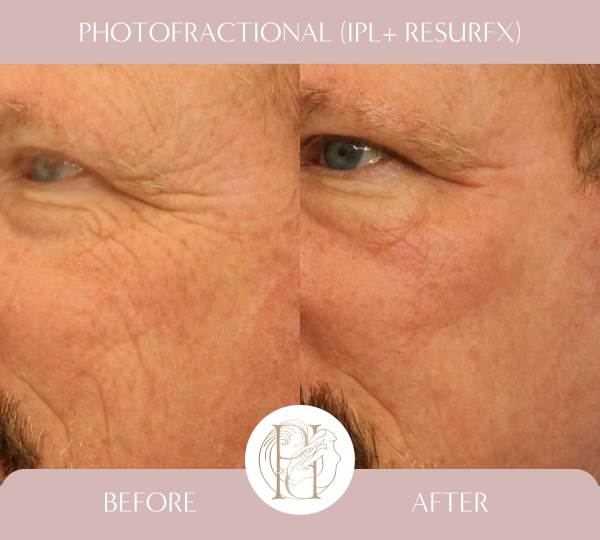 Four Photofractional Treatments (Full Face)