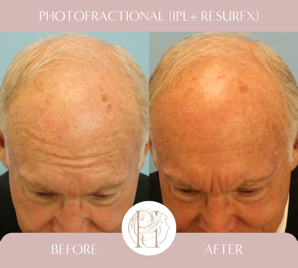 Two IPL and Two Photofractional Treatments (Face and Scalp)