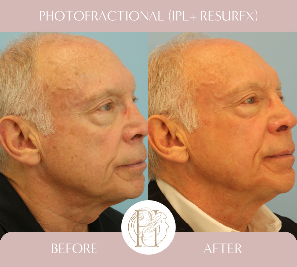 Two IPL and Two Photofractional Treatments (Face and Scalp)