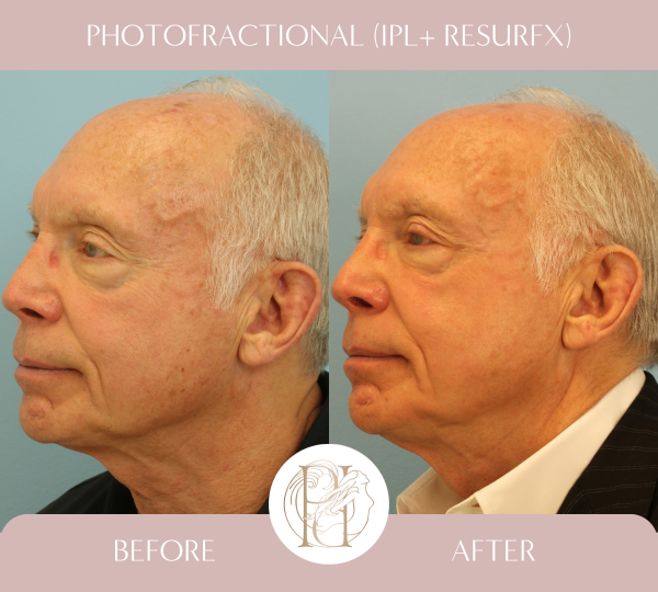 Two IPL and Two Photofractional Treatments (Face and Scalp)