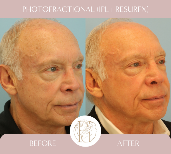 Two IPL and Two Photofractional Treatments (Face and Scalp)