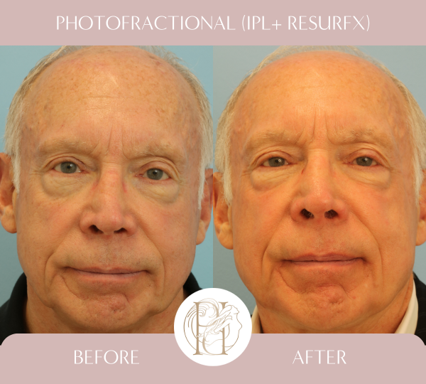 Two IPL and Two Photofractional Treatments (Face and Scalp)