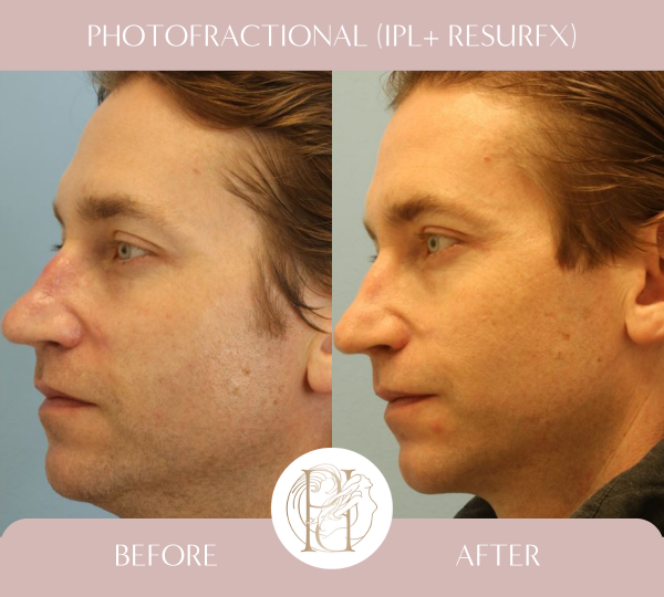 Patient had 3 photofractional (IPL + ResurFx) for cheeks & nose.