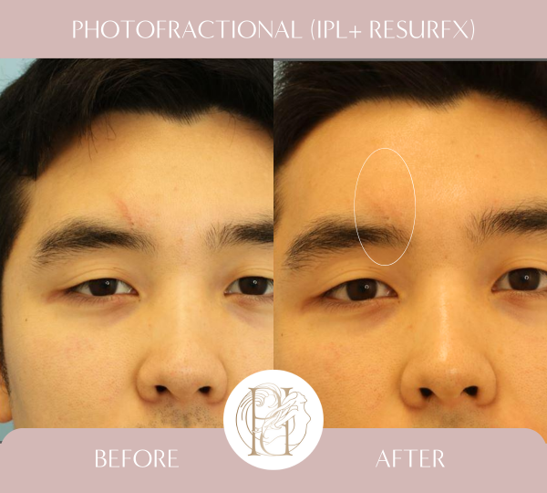 Five Photofractional Treatments (Scar on Forehead)