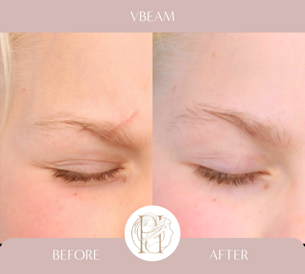 Vebam Scar 4 Treatments