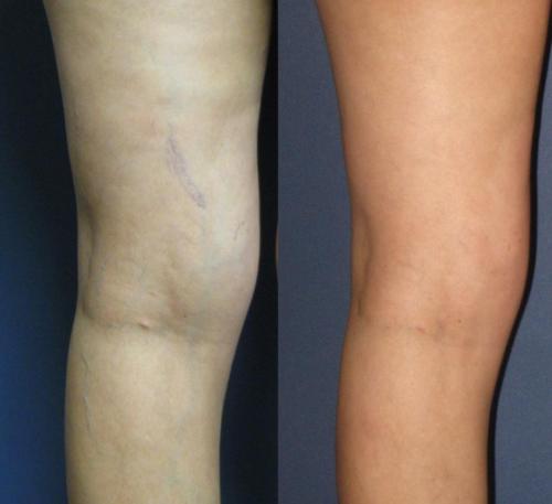 One Treatment Of Sclerotherapy