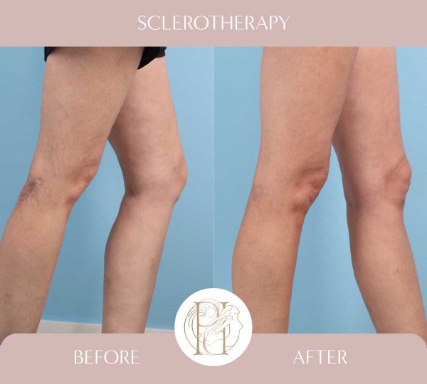 Sclerotherapy 1 of 4