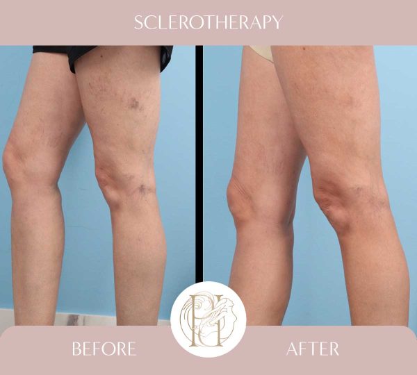 Sclerotherapy 2 of 4