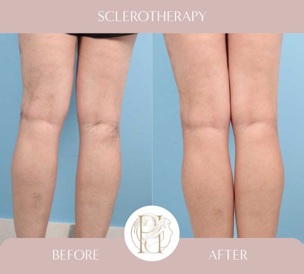 Sclerotherapy 3 of 4