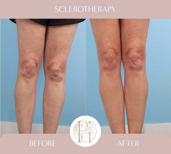 Sclerotherapy 4 of 4
