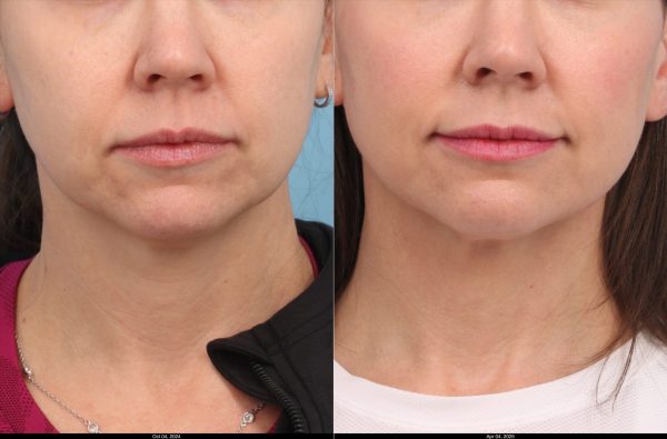 L.Boston-Ultherpy-Lower-Face-Upper-Neck-1