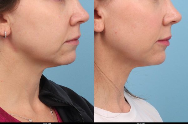 L.Boston-Ultherpy-Lower-Face-Upper-Neck-2